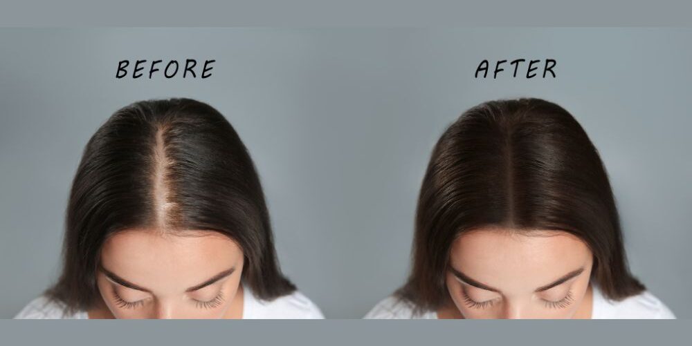prp-for-hair-growth-before-after