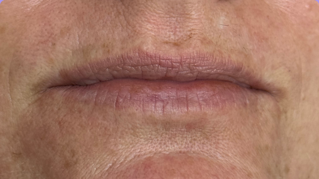 Before Lip Neutralization