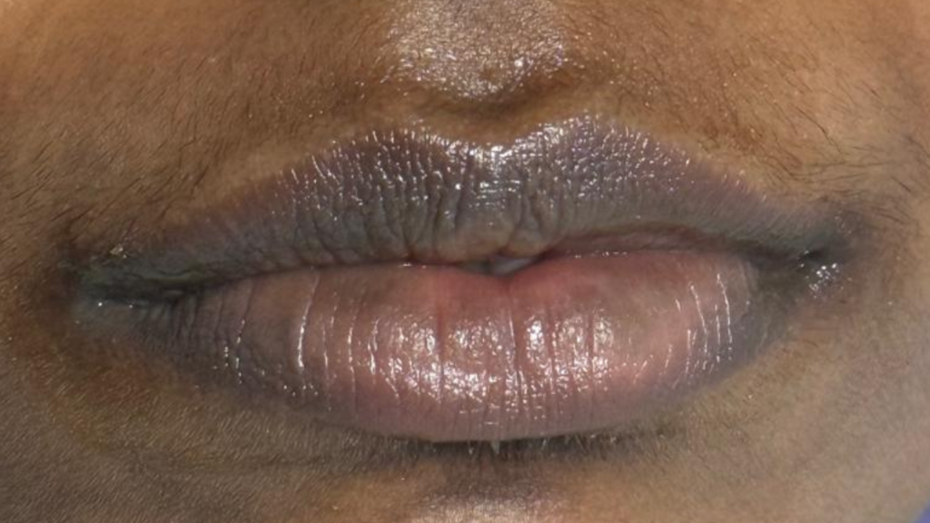 Before Lip Neutralization