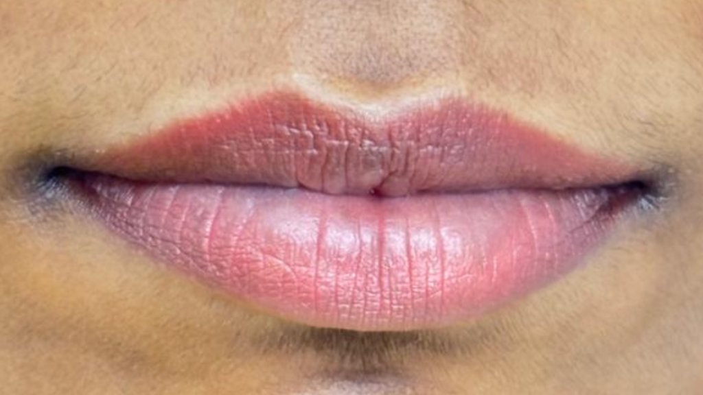 After Lip Neutralization