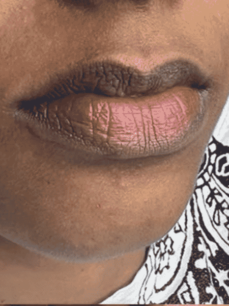 Before Lip Neutralization