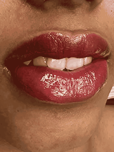 After Lip Neutralization