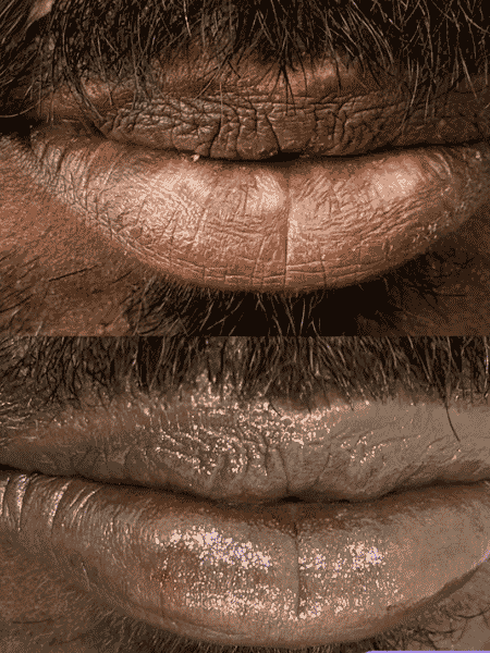 Vitiligo Lip Coverage