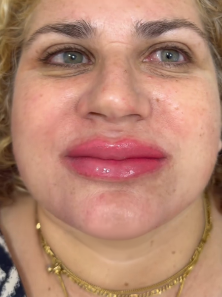 After Lip Blush