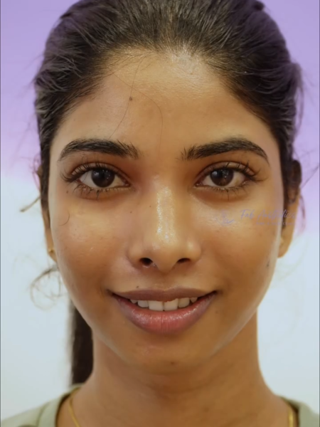 After Hydra Facial