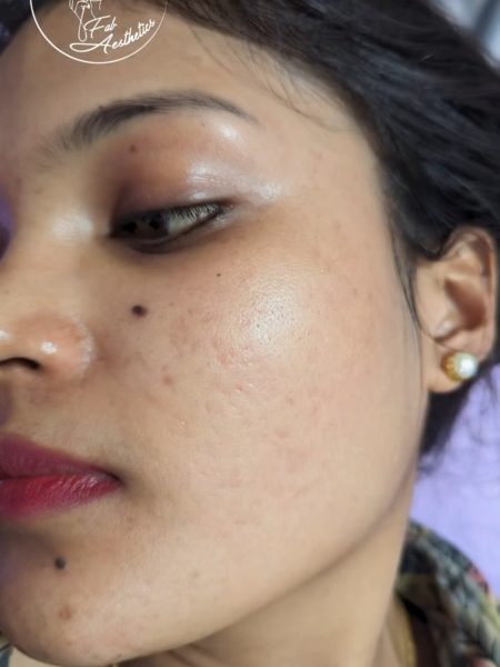 After Acne