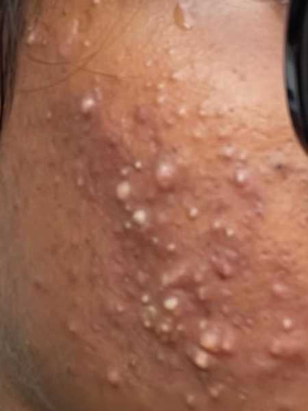 Before Acne