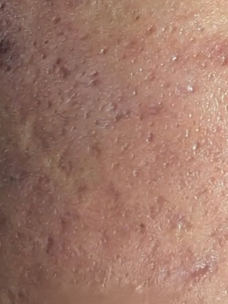 After Acne