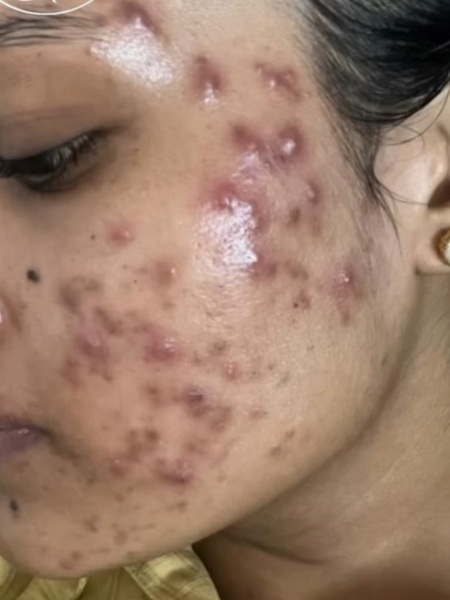 Before Acne